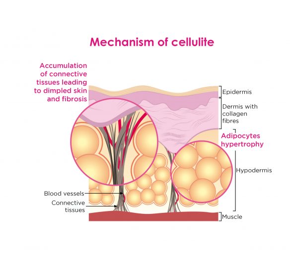mecanisme of cellulite