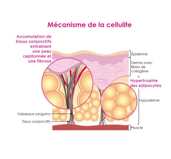 Schéma du mécanisme de la cellulite - Dimpless